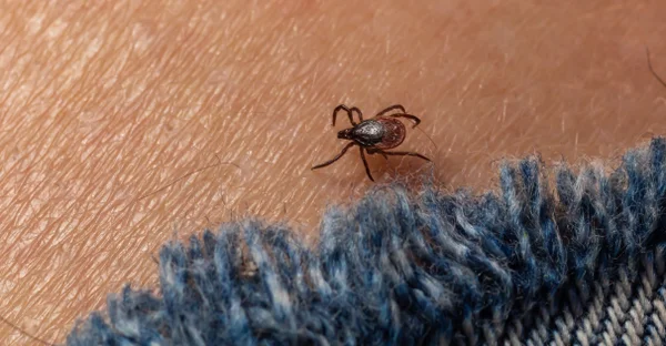 Infected female deer tick on hairy human skin