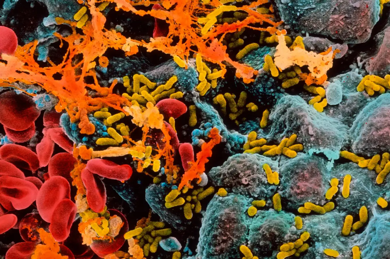A scanning electron micrograph of E coli (yellow) infecting cells (blue) within a human bladder, causing them to secrete thick mucus (orange)