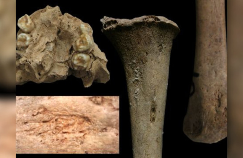 Prehistoric Vietnamese children's bones and teeth bearking marks of syphilis-like disease, April 11, 2026.