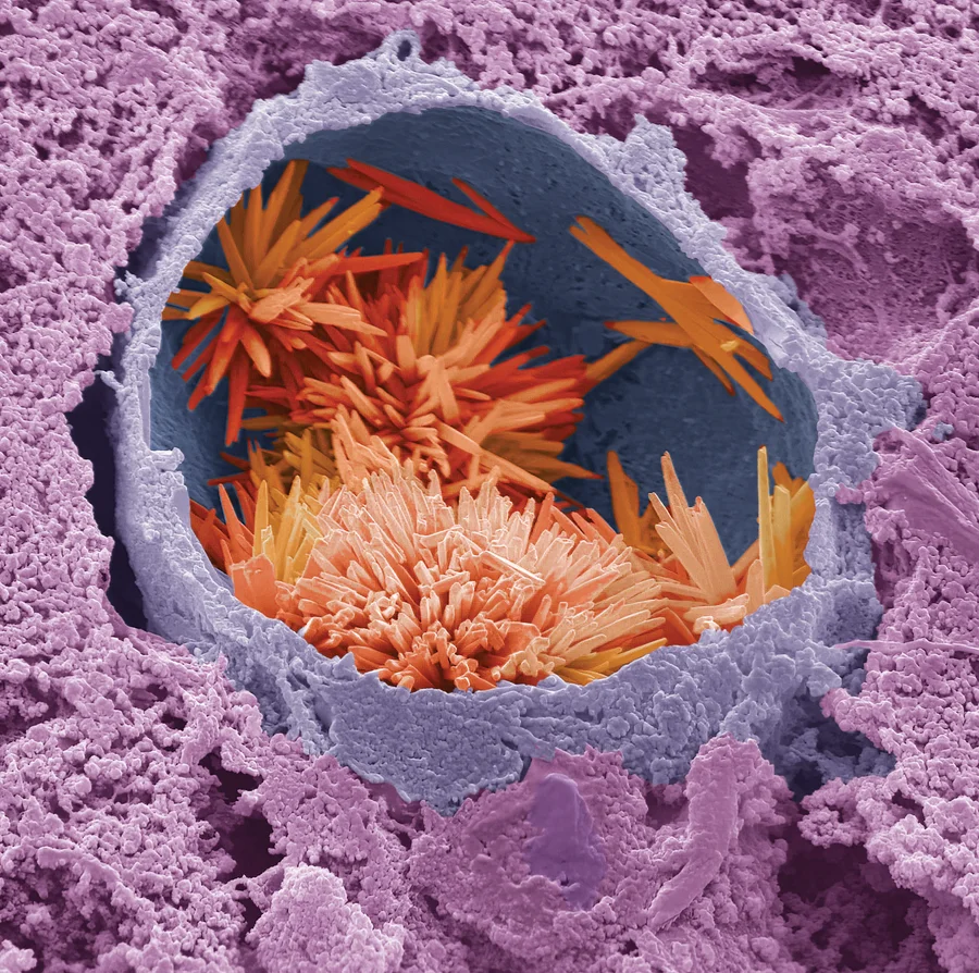 Colored scanning electron micrograph (SEM) of cholesterol crystals (red) within a lipid droplet (purple) in a human liver.
