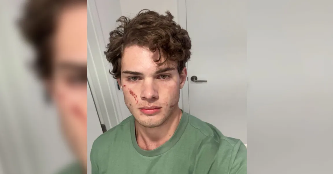 Braden "Clavicular" Peters, a so-called "looksmaxxing" influencer was hospitalized Tuesday evening for a suspected overdose.