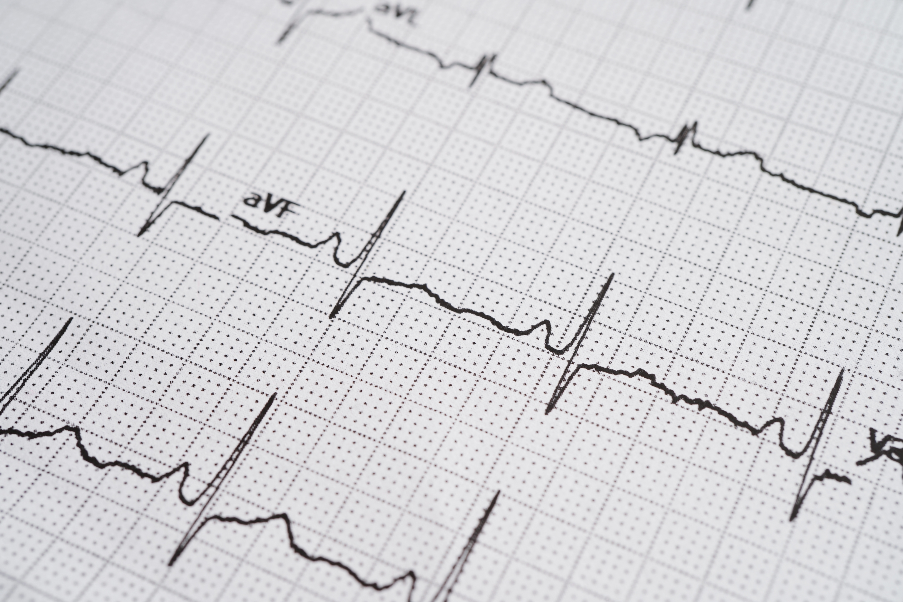 Imagen de un electrocardiograma, que registra la actividad el�ctrica del coraz�n en cada latido.