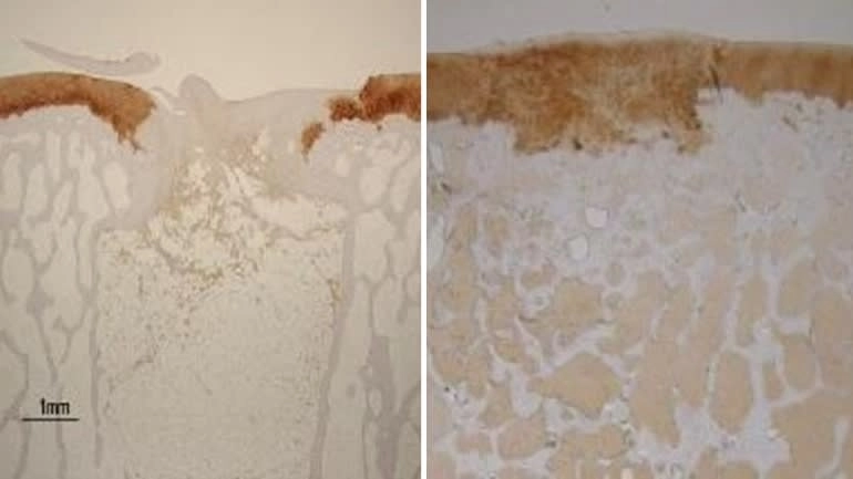 全球首例膝关节再生试验即将启动,提取脂肪细胞 3D 打印软骨与骨骼 再生前后的膝关节软骨与骨骼